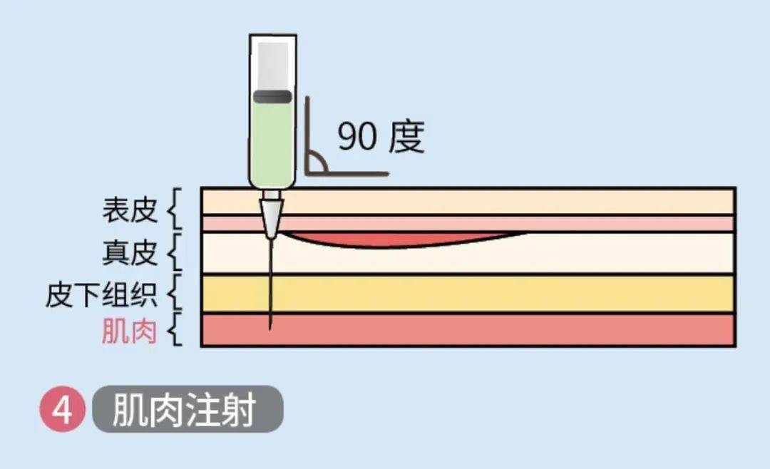 高压射流可以穿透皮肤,到达皮下一定深度后完成药物的释放.