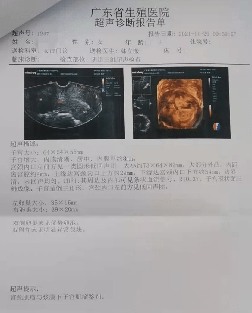 肝癌晚期b超诊断图片图片