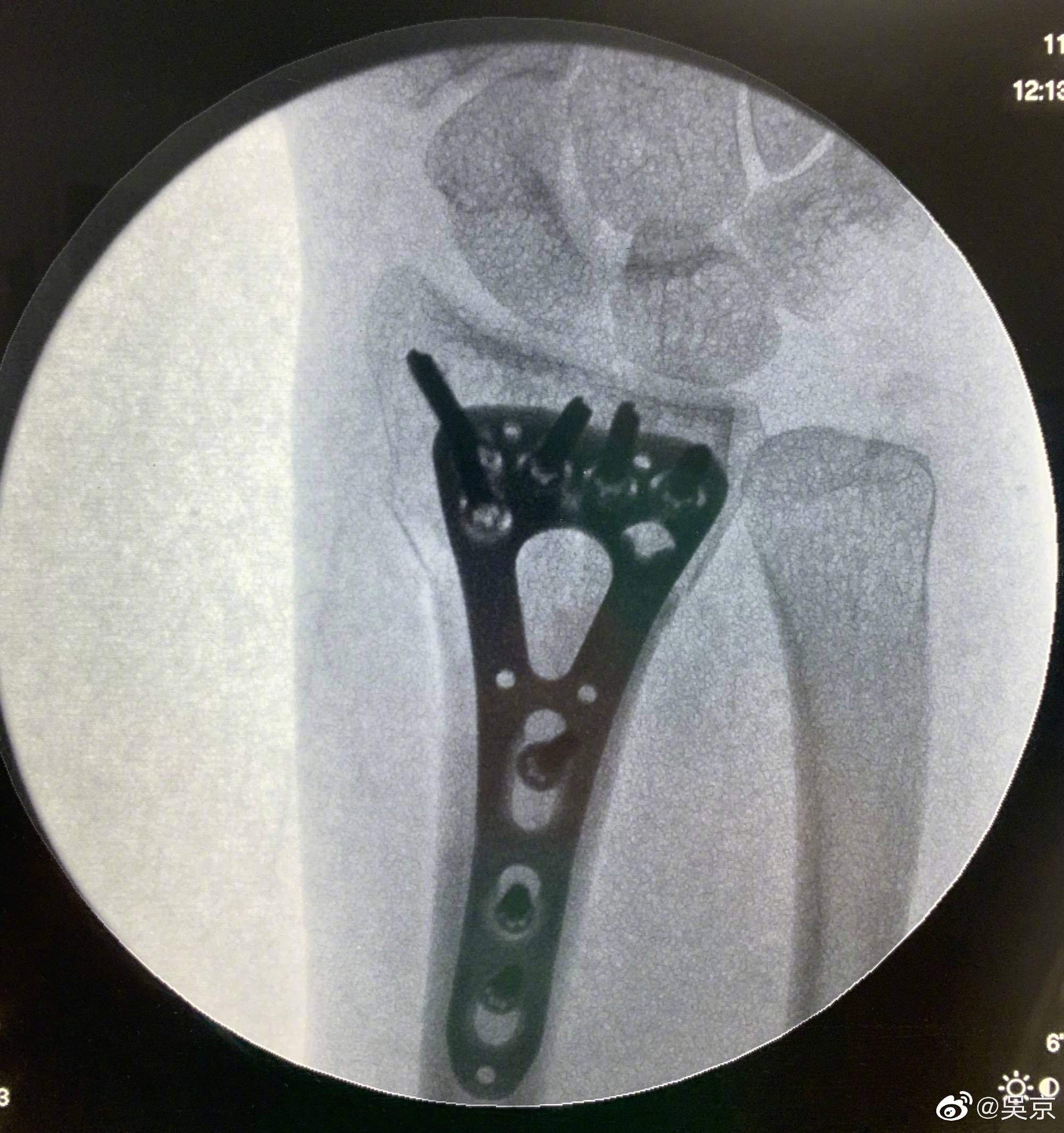 吴京晒出谢楠桡骨x光片,之前他说谢楠桡骨粉碎性骨折…………_康复