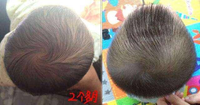 给孩子睡“扁头”?老一辈喜欢的扁头,医学上称为“扁平畸形”_宝宝_婴儿_圆头