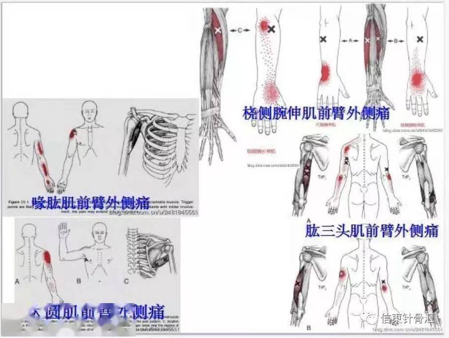 肌筋膜全身160个疼痛触发点