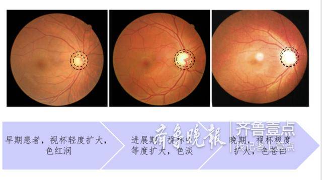 超过21mmhg),特征性视神经改变(视神经照相