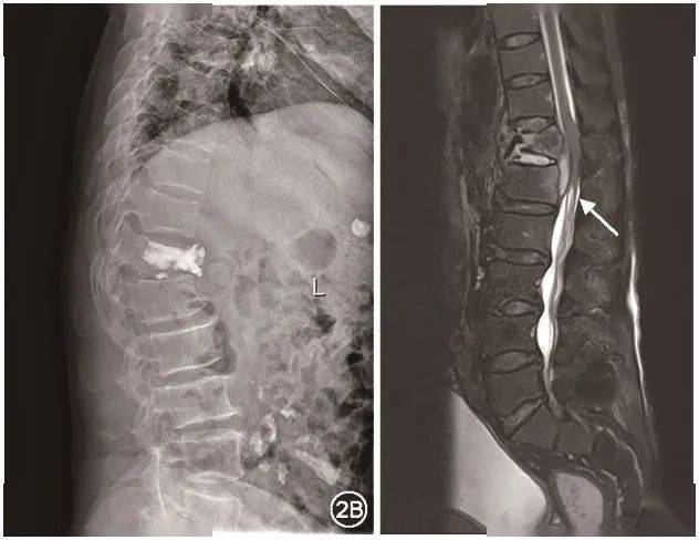 唐建東胸12椎體成形術後椎管內膿腫形成致圓錐馬尾綜合徵一例