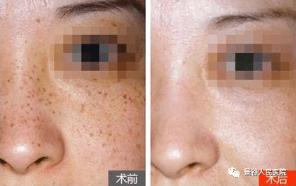 黄褐斑,色素痣,蓝痣,天性巨型色素痣,发育不良痣,黑素棘皮瘤,雀斑样痣