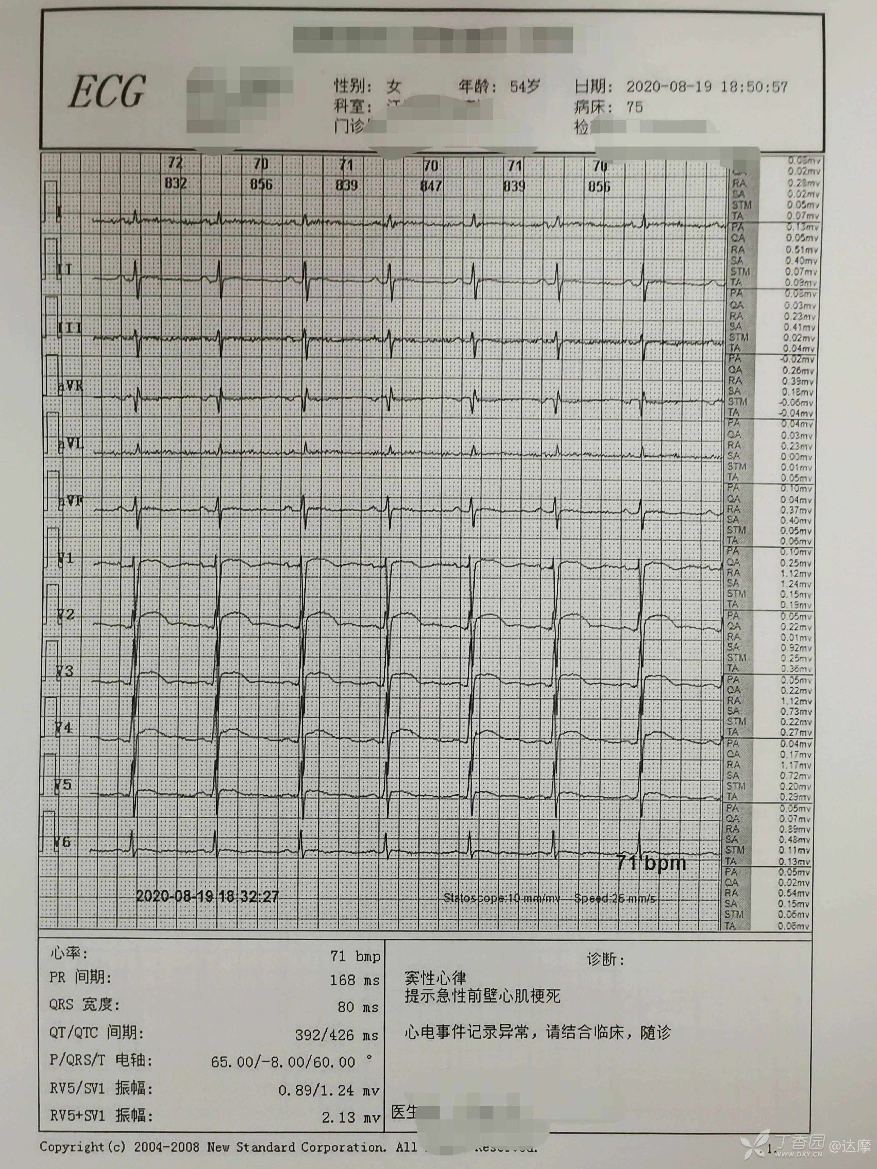 急性心梗心电图分期图片