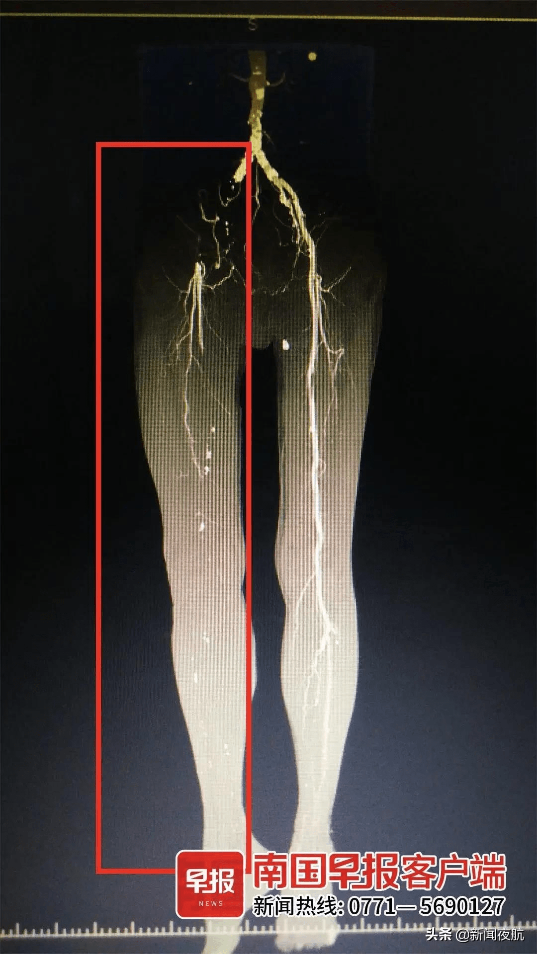 血管|惊！七旬老人突发“腿梗”？医生：再晚点儿或要截肢
