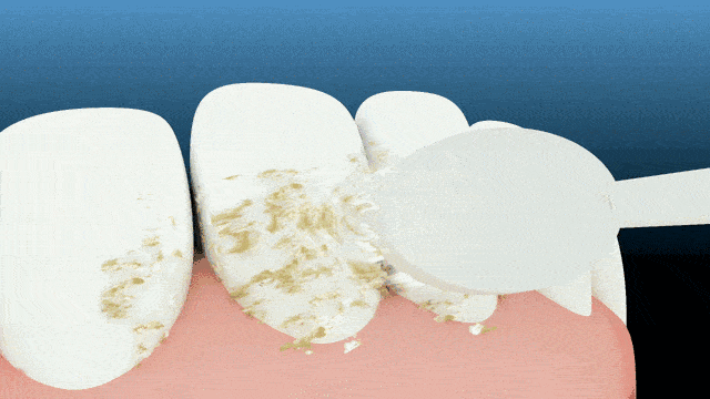 牙缝里|「牙齿橡皮擦」?一刷香口、黄渍消，二刷牙齿白如雪！