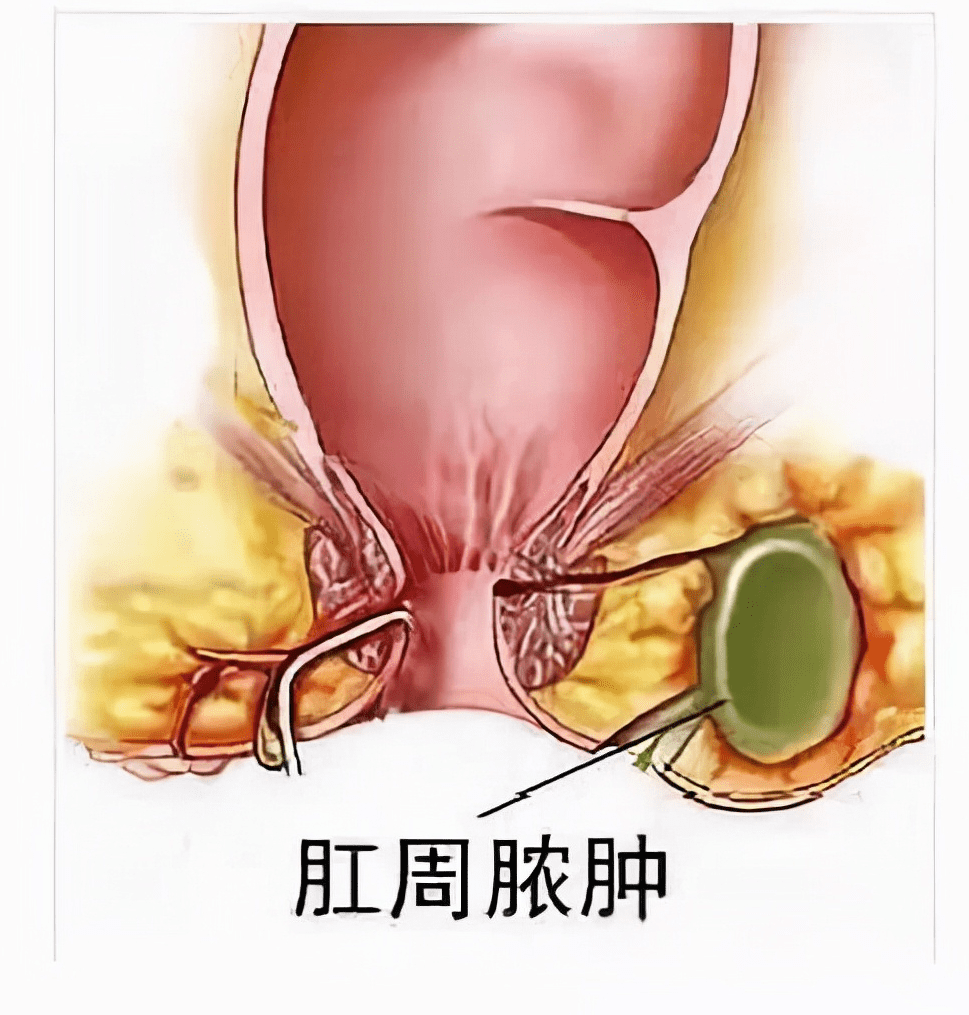 肛门直肠周围脓肿图片图片