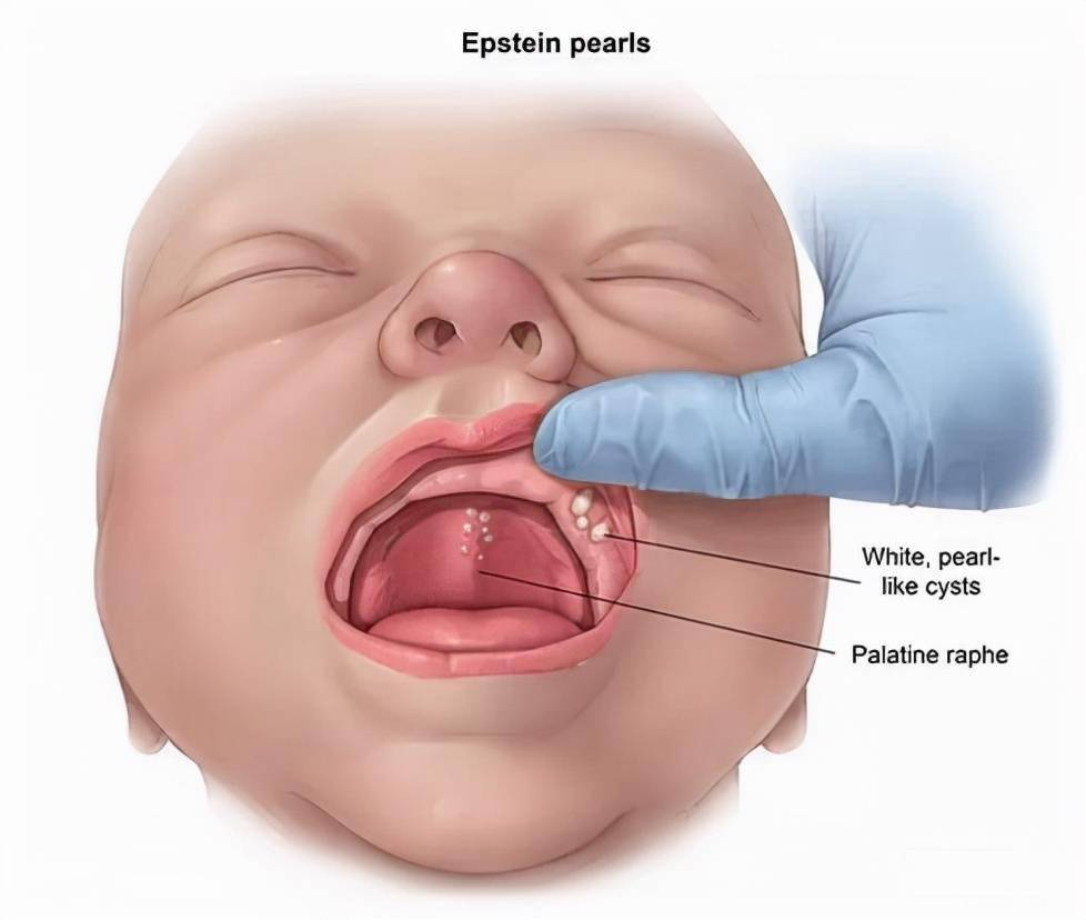新生儿上颚图片图片
