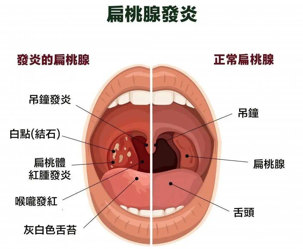咽扁桃体的位置图片