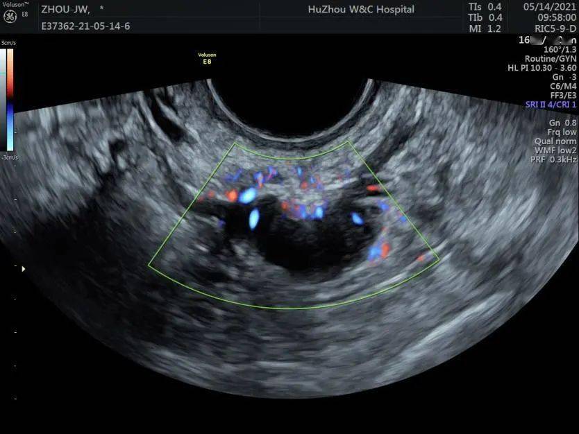 肠道子宫内膜异位症的超声诊断