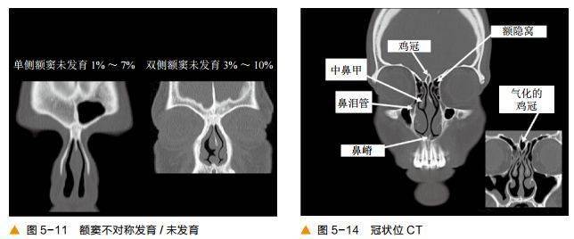 前后筛窦以中鼻甲基板为界,蝶窦及后组筛窦以上鼻甲基板为界