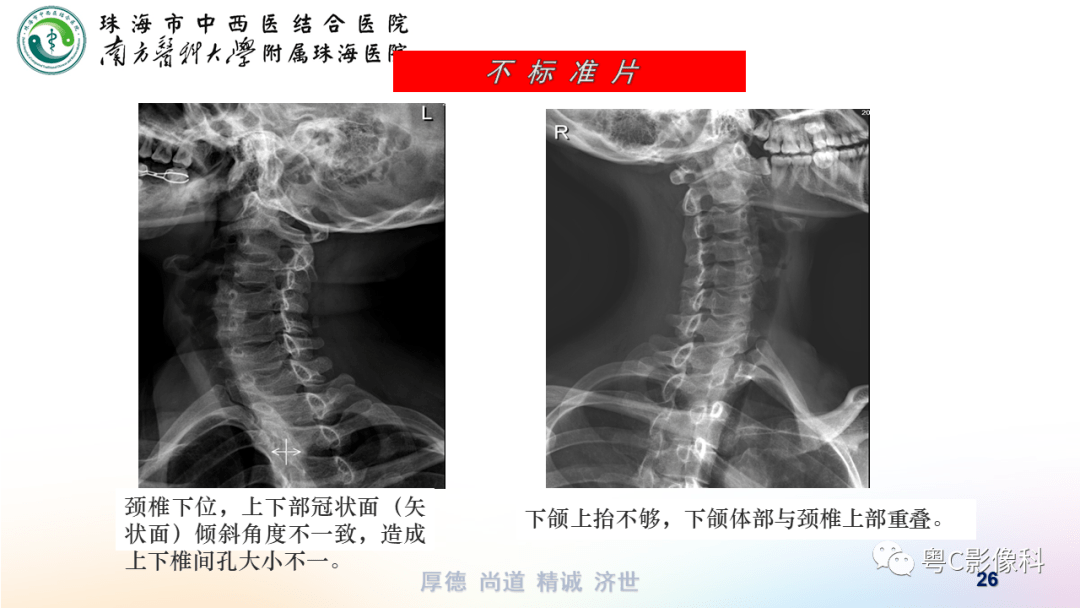 頸椎dr拍攝技術必須掌握的基本功