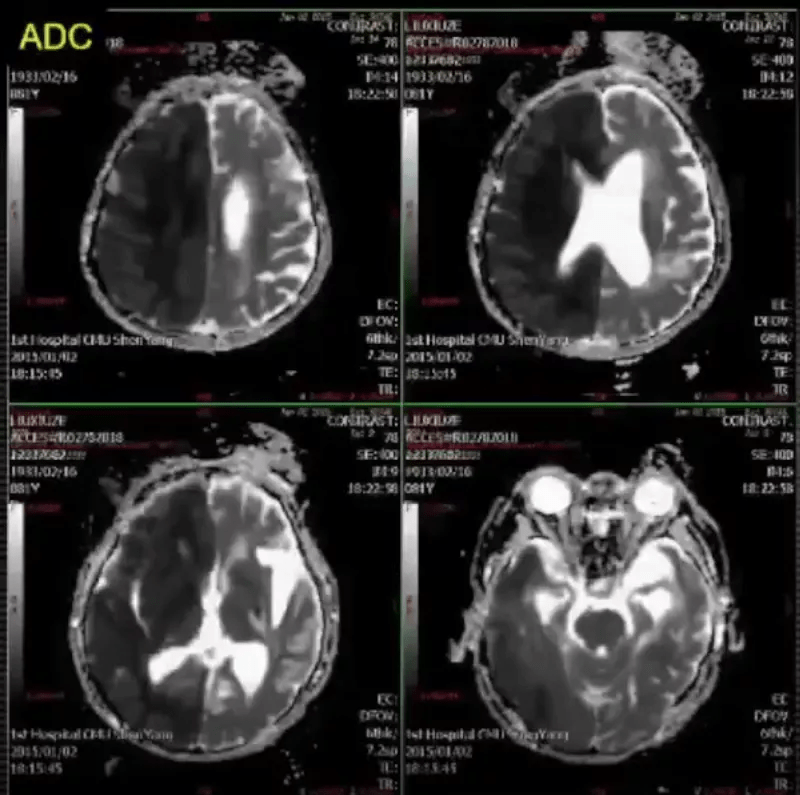 治疗|急性脑梗死MRI的临床特点，超强解读