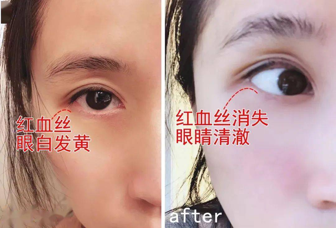 眼睛眼睛的“回春药”找到了，睡前戴它，25分钟蒸走干涩 、黑眼圈，还你明眸！