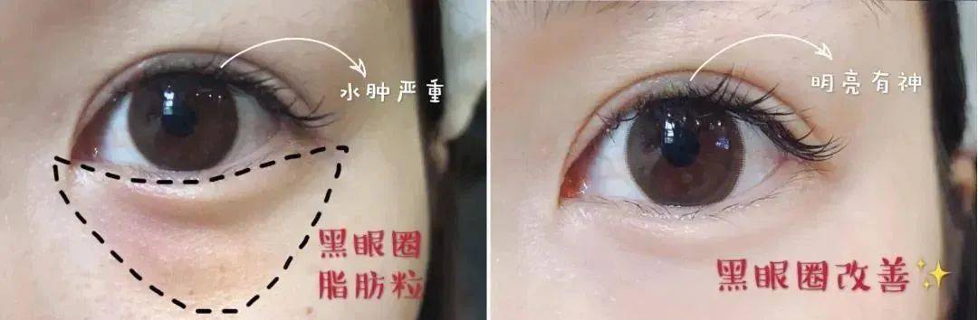 眼睛眼睛的“回春药”找到了，睡前戴它，25分钟蒸走干涩 、黑眼圈，还你明眸！