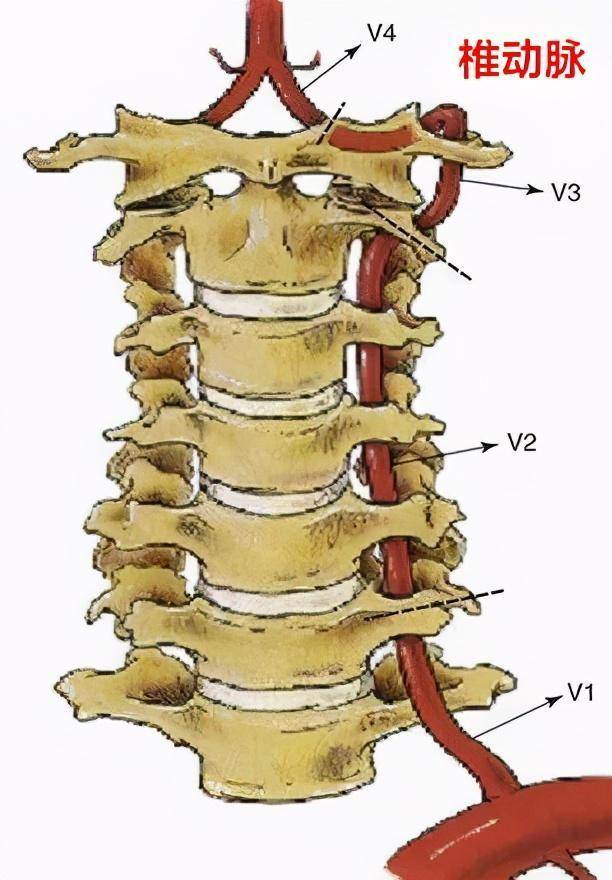 椎动脉型颈椎病的患者往往颈椎不稳定或有增生,以致于转动颈椎的时候
