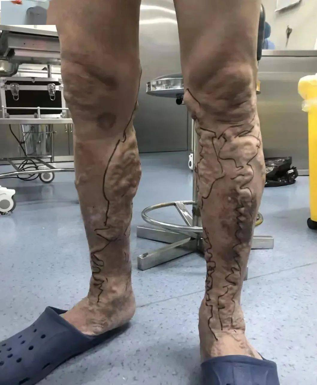 腿上"爬满蚯蚓" 因为一个手术 奇迹出现了……_血管_患者_下肢