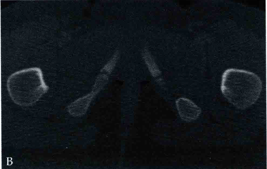 易误诊的骨盆假性骨折 正常骺线 软骨 耻骨 中心