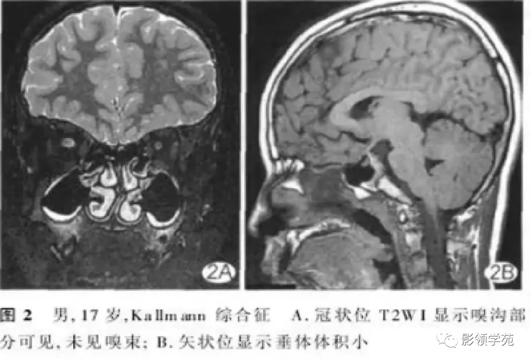 Rathke|垂体解剖及常见病变影像学表现