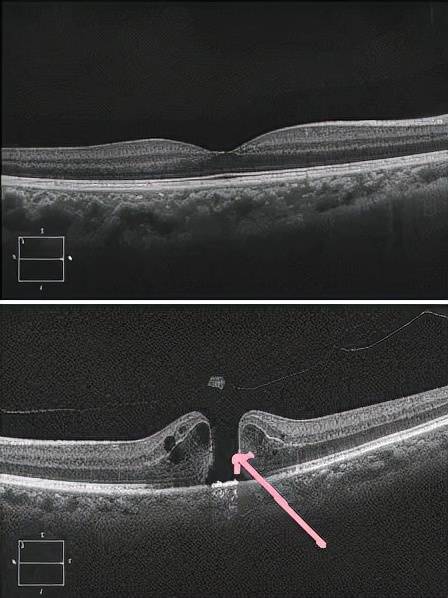 高度近视还可能导致失明!_病变_眼底_患者