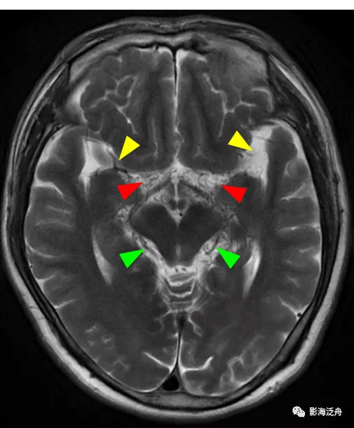诊断|颅脑MR平扫中极易漏诊的点