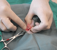 睾丸摘除手术步骤图图片