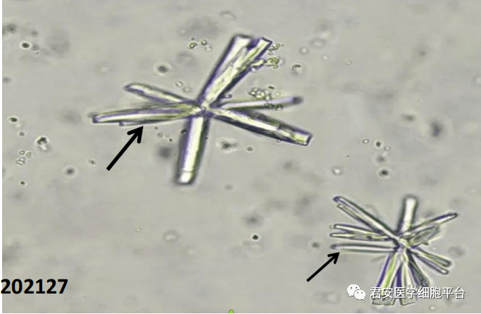 點擊空白處查看答案磷酸鈣結晶202128尿沉渣塗片 未染色 400x點擊空白