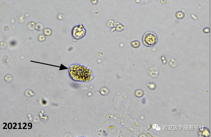 點擊空白處查看答案脂肪顆粒細胞復粒細胞202130尿沉渣塗片 未染色