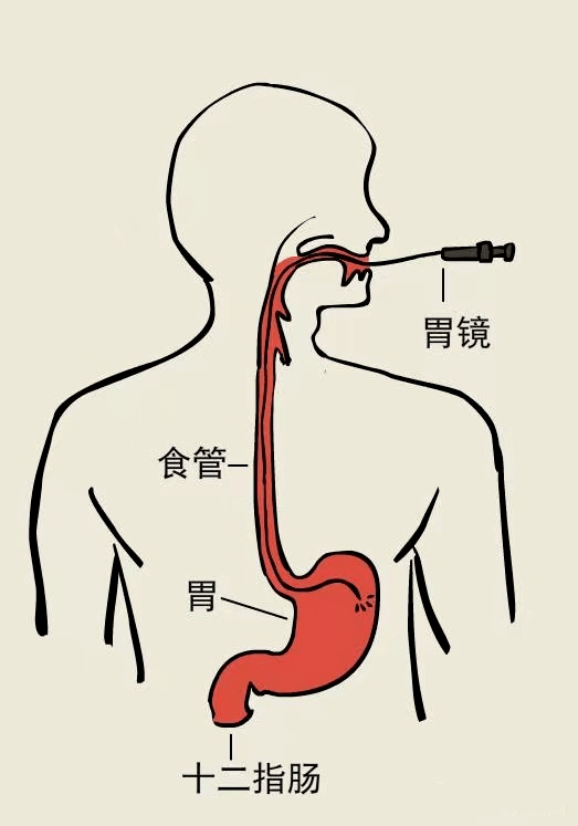 胃镜各个部位名称及图图片