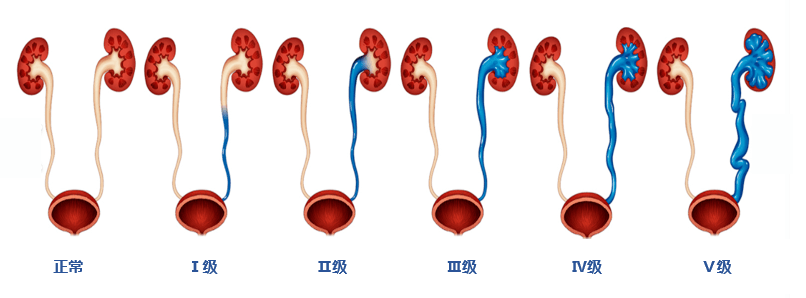 膀胱输尿管反流图片