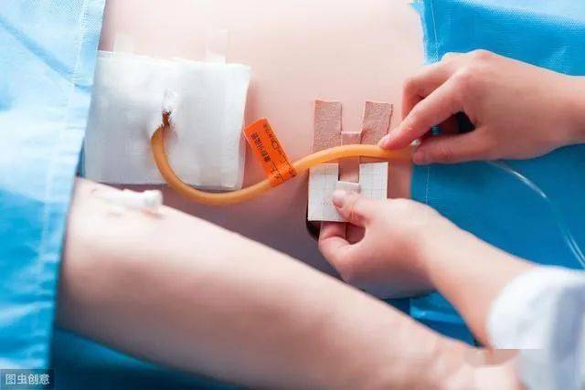 术后留置腹腔引流管后我们应该要注意那些