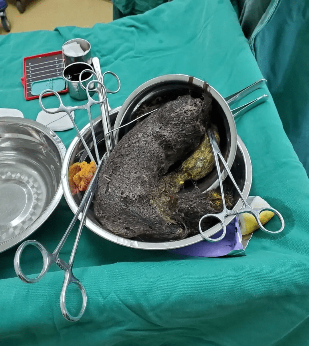 广西一13岁小女孩反复腹痛半月余医生从其胃里取出一大团头发