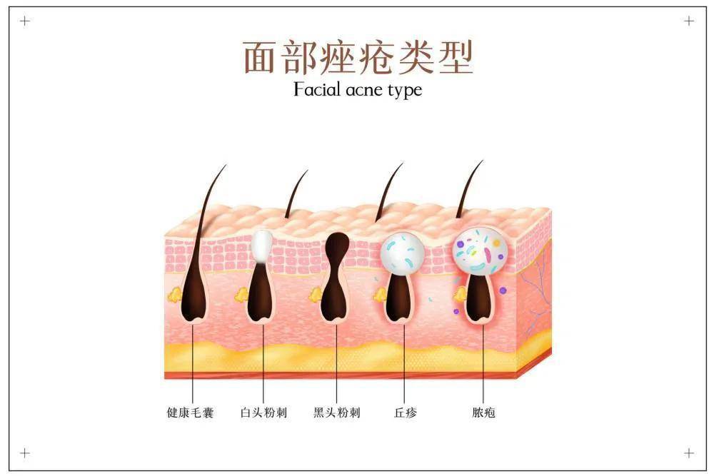 点火针中成药 火针化疗自以为是湿疹