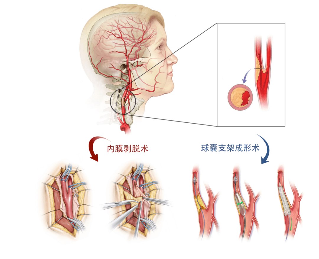 颈动脉外膜剥脱术图片