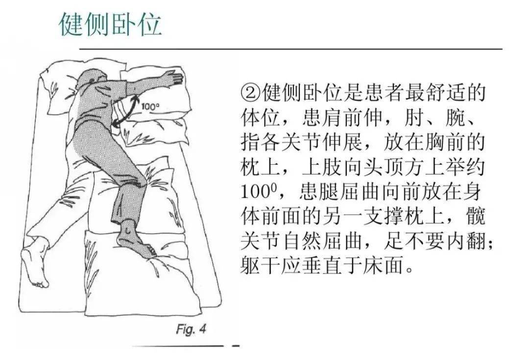 肩痛,肩手综合征,骨盆后倾,髋关节外展,外旋以及早期诱发分离运动等均