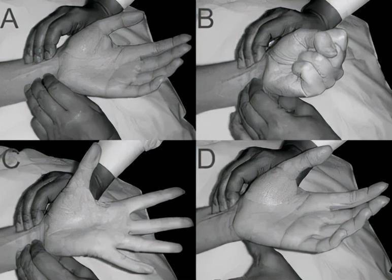 改良的结果对allen试验患者进行分类:正常(0-5秒),中度(6-10秒)或异常