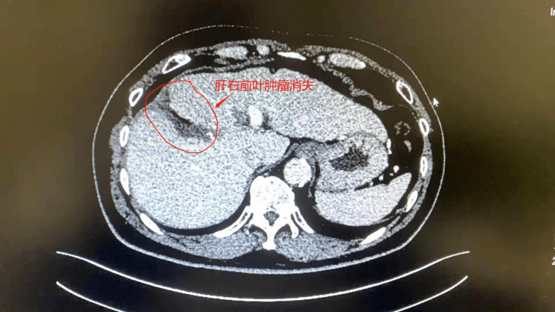 妙手拆弹龙川县人民医院普外科成功实施多例腹腔镜下解剖性肝切除术
