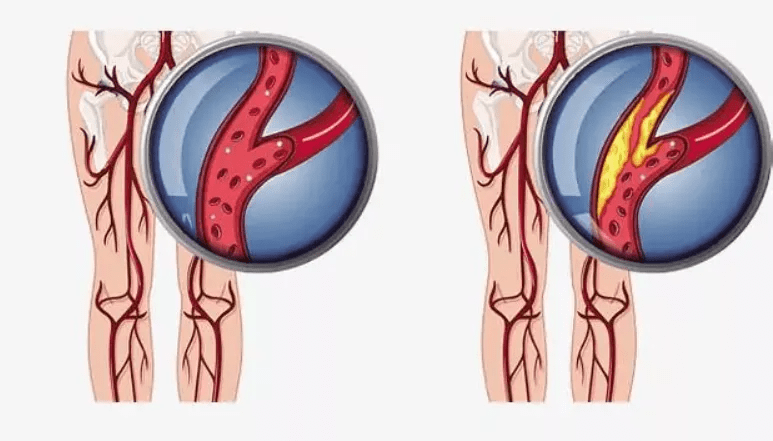 下肢动脉硬化闭塞症?