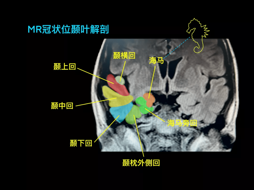 mr 冠状位颞叶解剖中脑