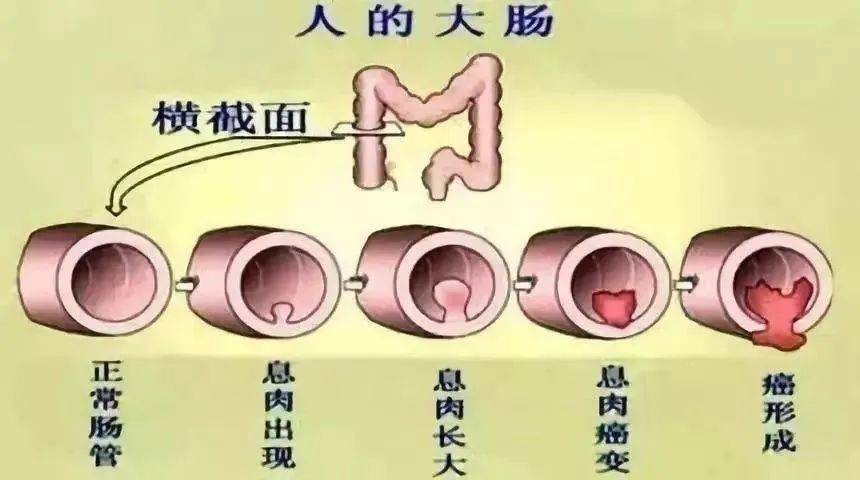 直肠结肠息肉怎么办