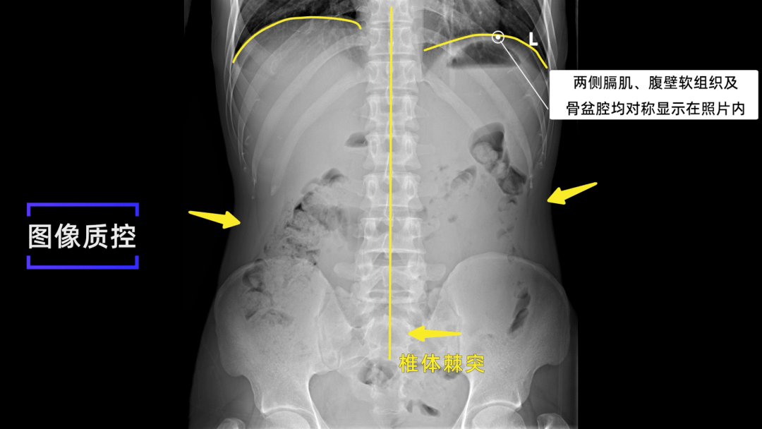 女性腹部x光图片
