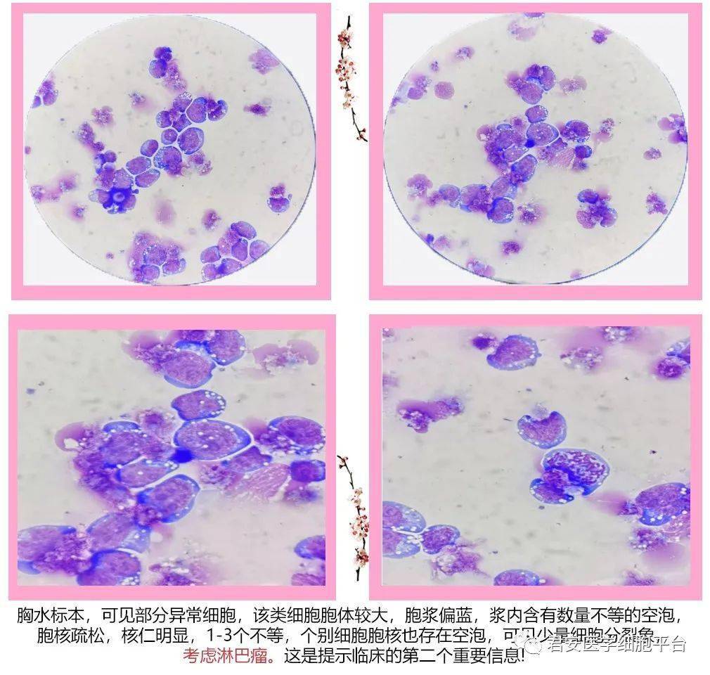 點圖和儀器報警信息都已經觸犯血細胞分析複檢規則,須進行顯微鏡複檢