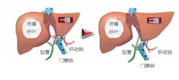 肝脏|【首儿医典】肝母细胞瘤