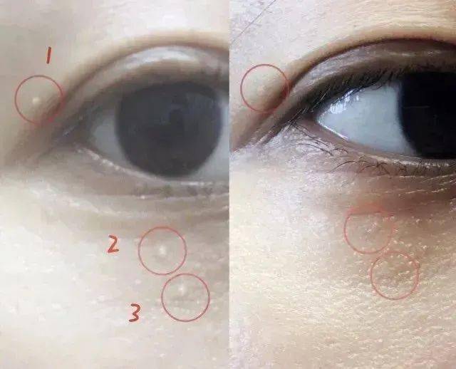 医学长了脂肪粒到底挤不挤?一分钟教你处理它的正确姿势!