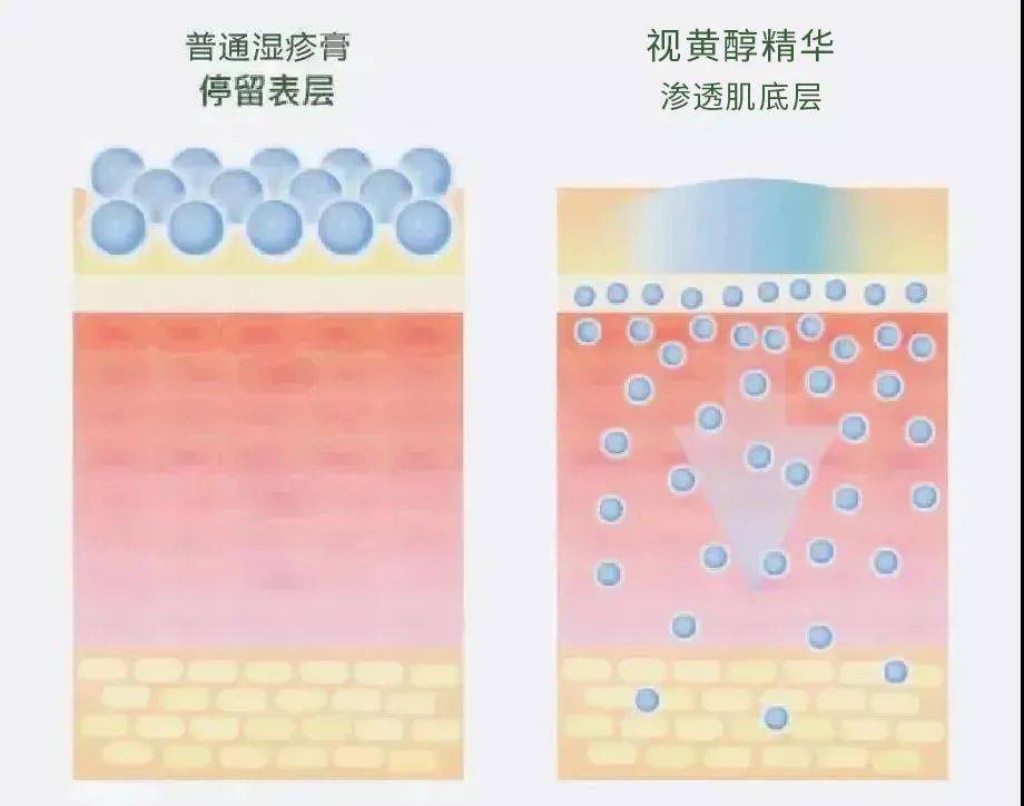 医学长了脂肪粒到底挤不挤?一分钟教你处理它的正确姿势!