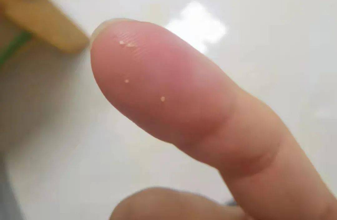 医学长了脂肪粒到底挤不挤?一分钟教你处理它的正确姿势!