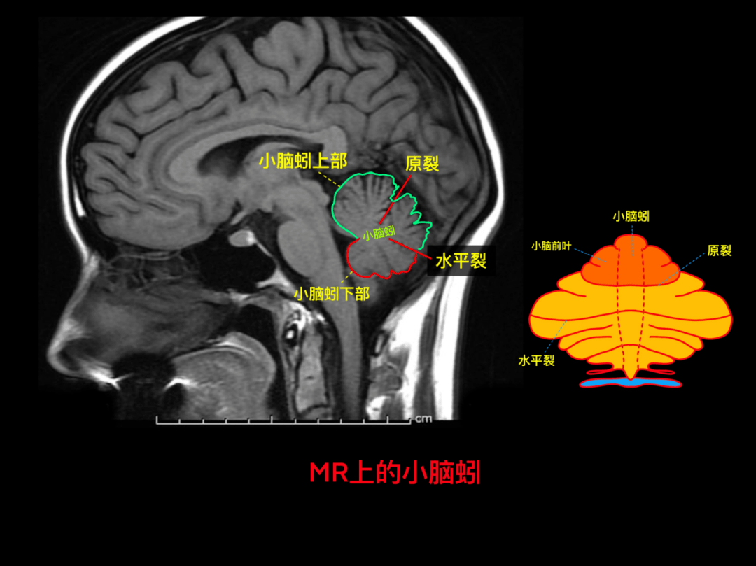 松果體基礎神經生理mr 上下丘腦的位置顱腦 mr 閱片的 keypoint(三)