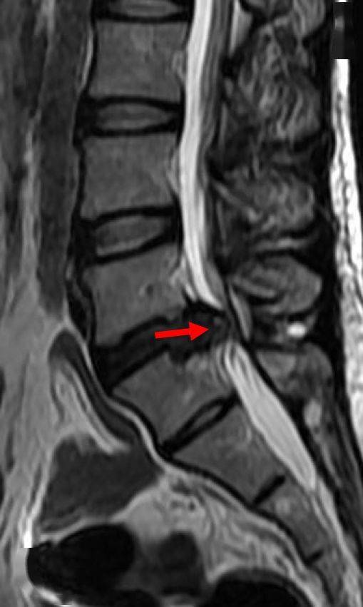 这6种椎间盘突出的影像征象别忽视