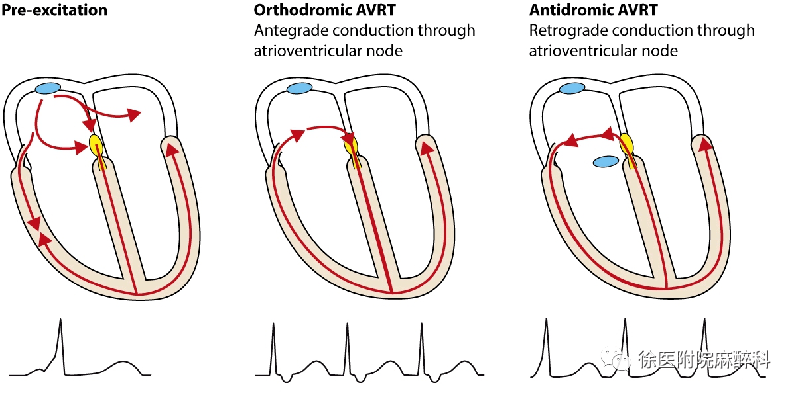 预激综合征的麻醉管理_心电图_旁路_窦性